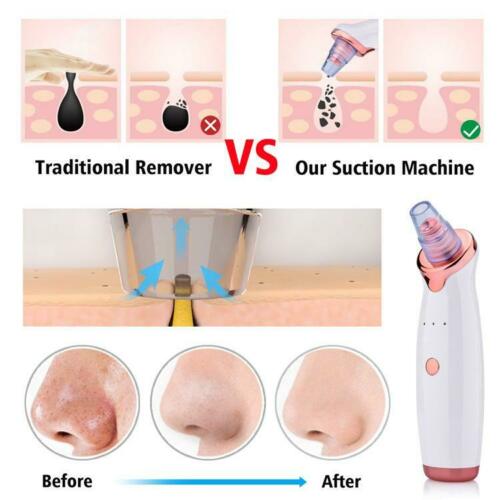 Electric Blackhead Remover Dermabrasion Face Cleaner